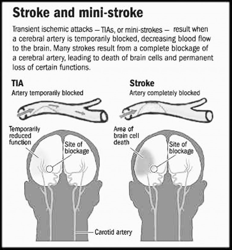 ‘Mini strokes’ can be a warning A stroke may follow New Orleans